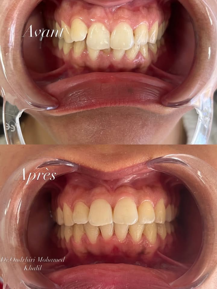 Avant et après un traitement orthodontique, vue de face avec écarteurs : les incisives, d’abord décalées, sont alignées après le traitement.