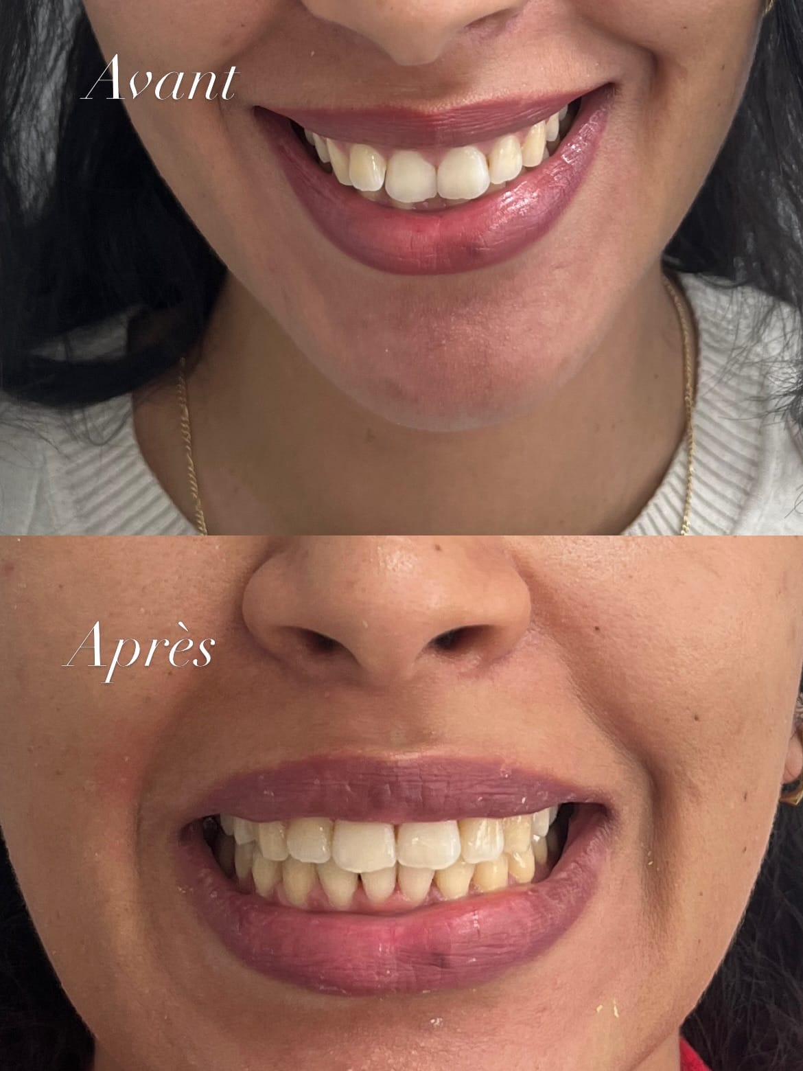 Sourire d’une patiente avant et après un traitement orthodontique au cabinet